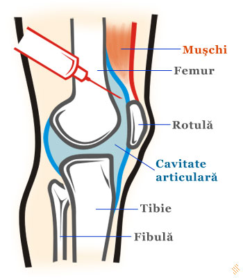 Artrocenteza genunchi - punctie articulara