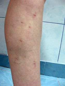 phlebology varicose veins treatment