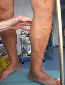 varicose veins treatment - before syrgery