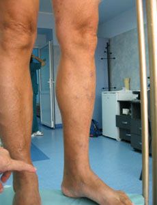 varicose veins treatment - after syrgery