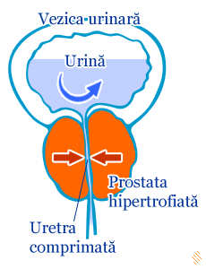 presiune urinară slabă prostatita)