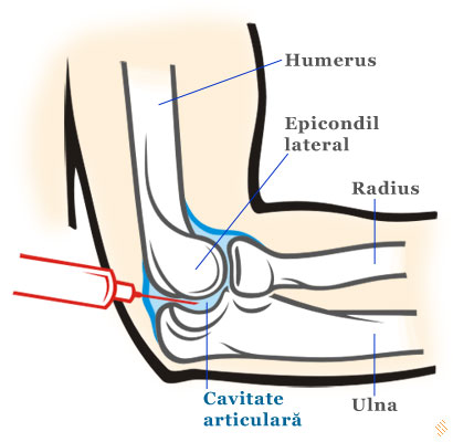 tratament articular de artropatie artrita cu durere pe deget