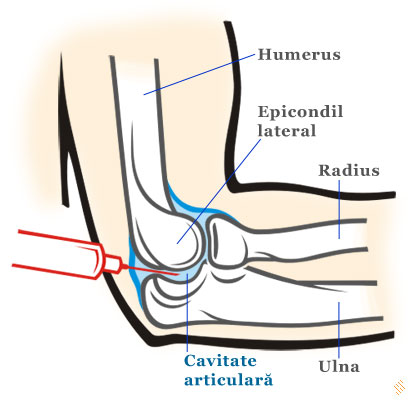 tratament seric articular)