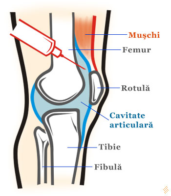 puntea de tratament articular)