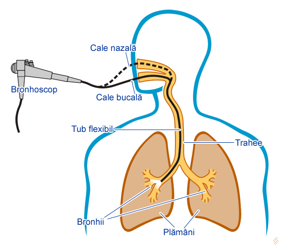 Micozele pulmonare pe radiografia toracică