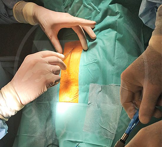 hiperplasia prostática tratamiento modula trata prostatita congestiva