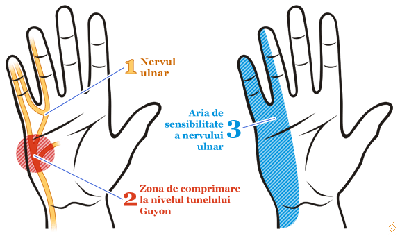 Neuropatia ulnara - paralizia nervului ulnar