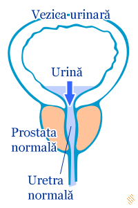 Probleme de prostată