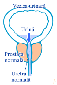 presiune ca în prostatita