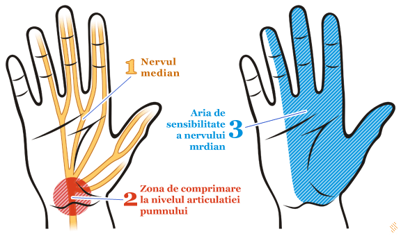 tratamentul sindromului de încheietura mâinii