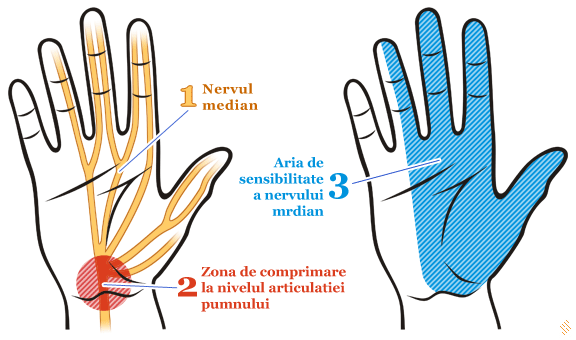 artroza carpică carpală de 1 deget)