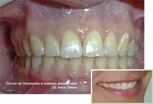 Diastema (strungareata) dupa tratament