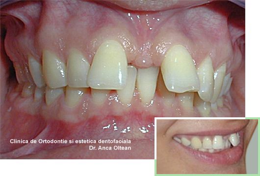 Diastema (strungareata) inainte de tratament