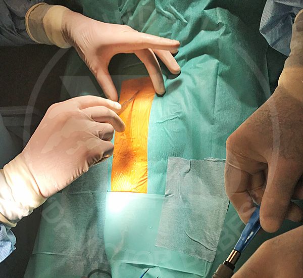 Fotovaporizarea cu laser verde | Operatie prostata marita