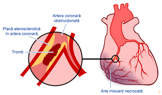 developing Decrement in case Infarctul miocardic