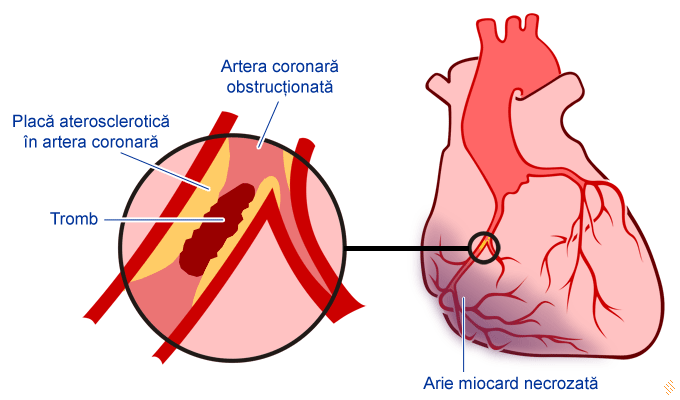 infarct miocardic artroza din ceea ce rănesc articulațiile