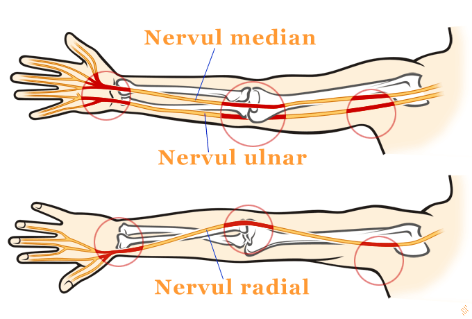 Paralizia nervului radial - neuropatia radiala