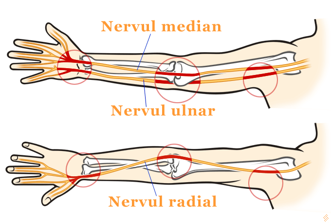 Paralizia nervului ulnar - neuropatia ulnara