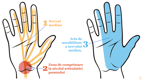 tratamentul afectării ligamentului la încheietura mâinii