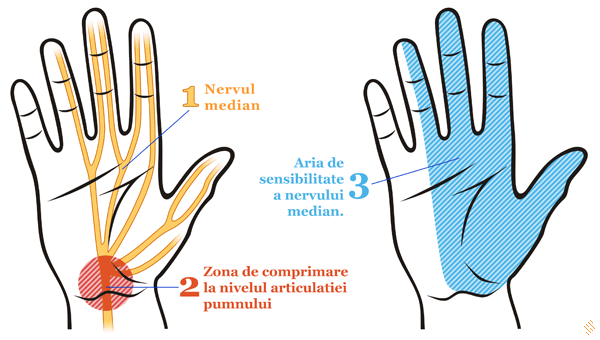 Paralizia nervului ulnar - neuropatia ulnara