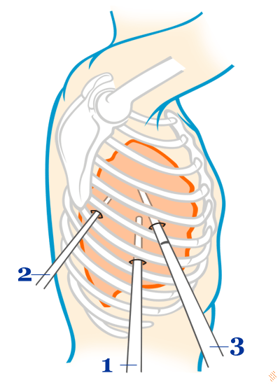 Toracoscopie - procedura chirurgicala