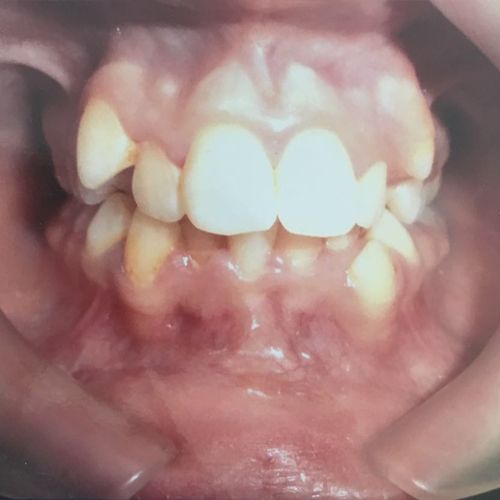 Tratament ortodontic, foto faţă, inainte de tratament