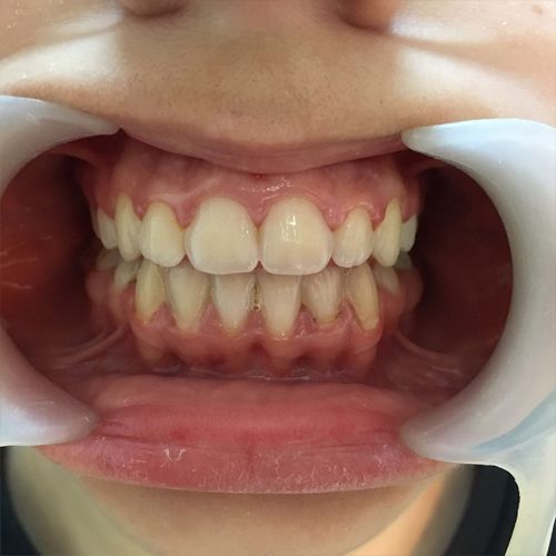 Tratament ortodontic, foto faţă, dupa tratament
