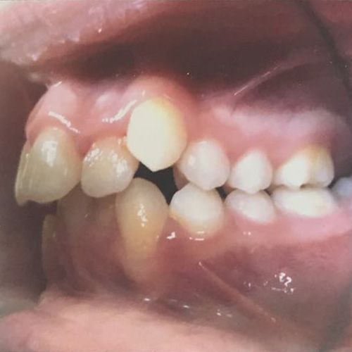 Tratament ortodontic, foto profil, inainte de tratament