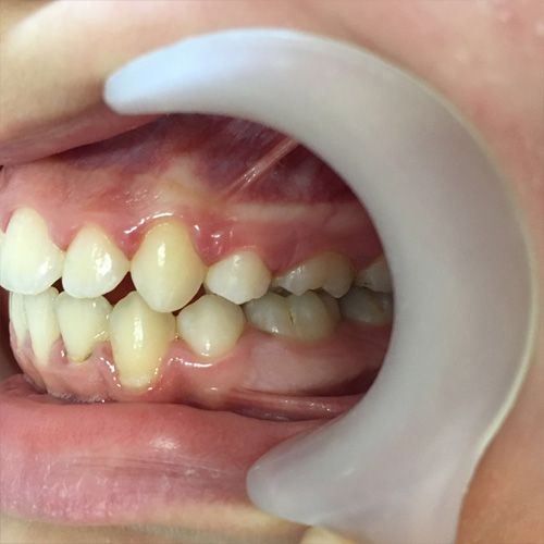 Tratament ortodontic, foto profil, dupa tratament