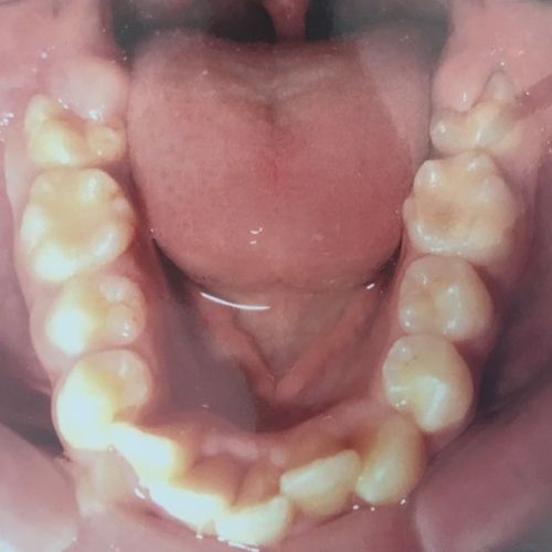Tratament ortodontic, foto mandibula, inainte de tratament