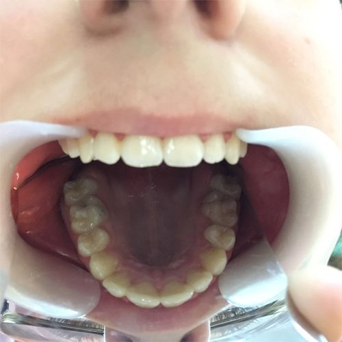 Tratament ortodontic, foto mandibula, dupa tratament