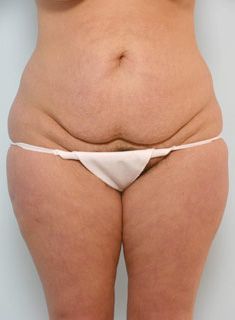 abdominoplastie