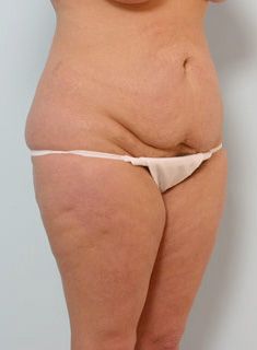 abdominoplastie