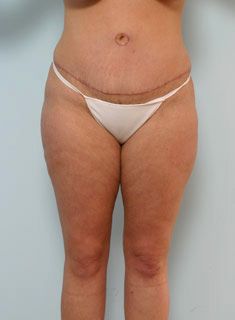 abdominoplastie