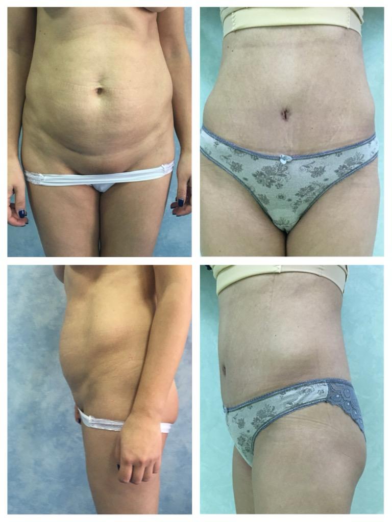 abdominoplastie