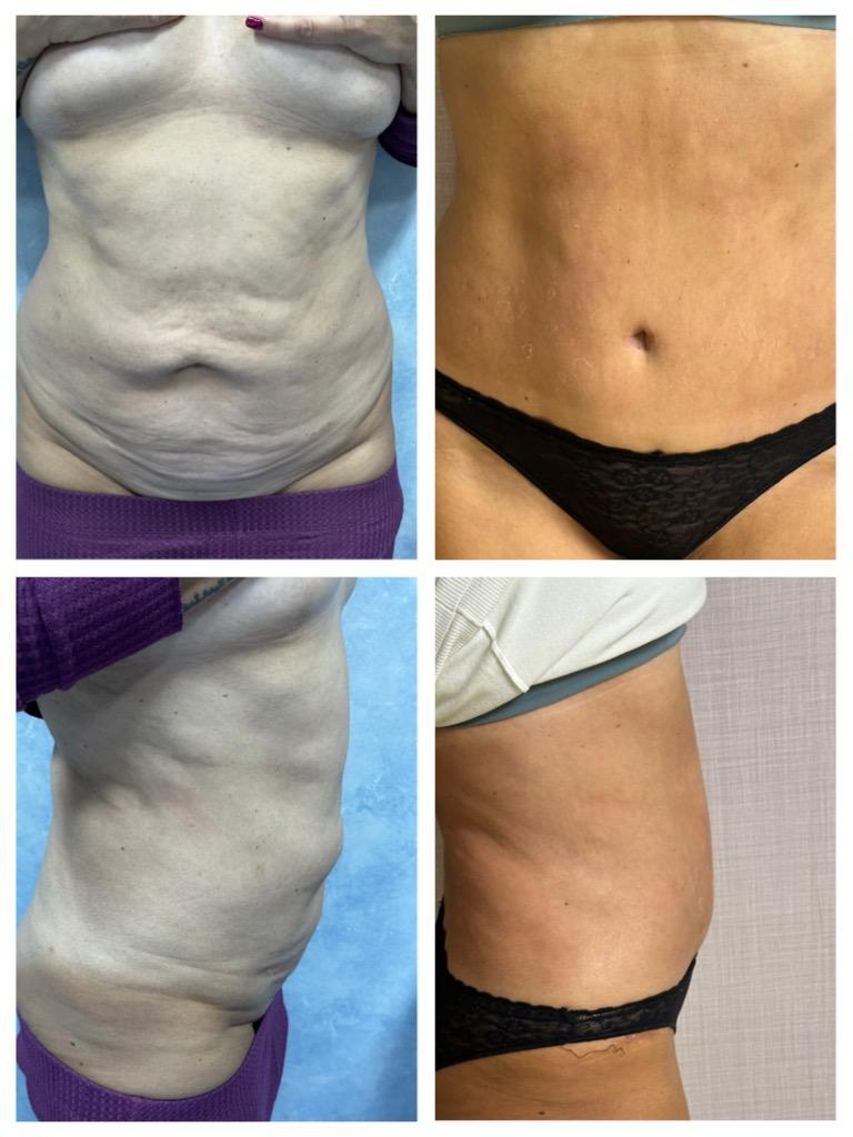 abdominoplastie