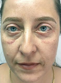 Blefaroplastie - dupa interventie