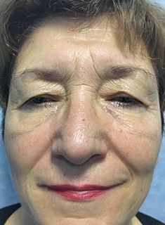 Blefaroplastie - inainte de interventie