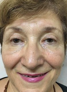 Blefaroplastie - dupa interventie