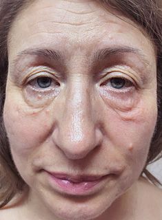 Blefaroplastie - inainte de interventie