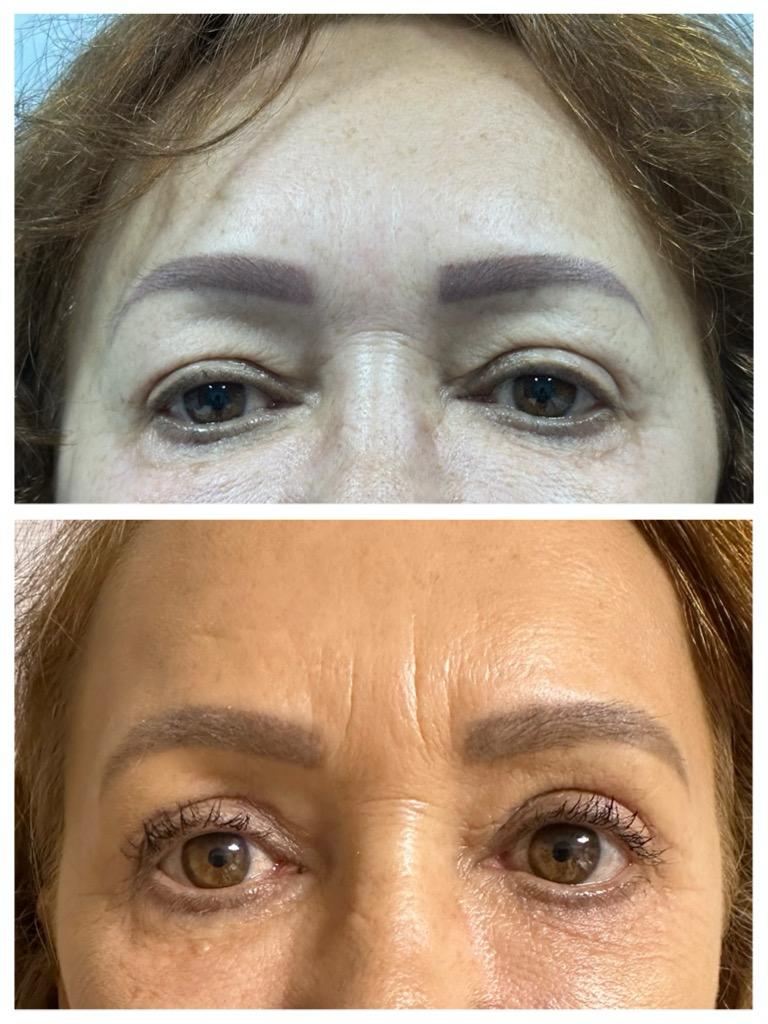 Blefaroplastie - inainte de interventie
