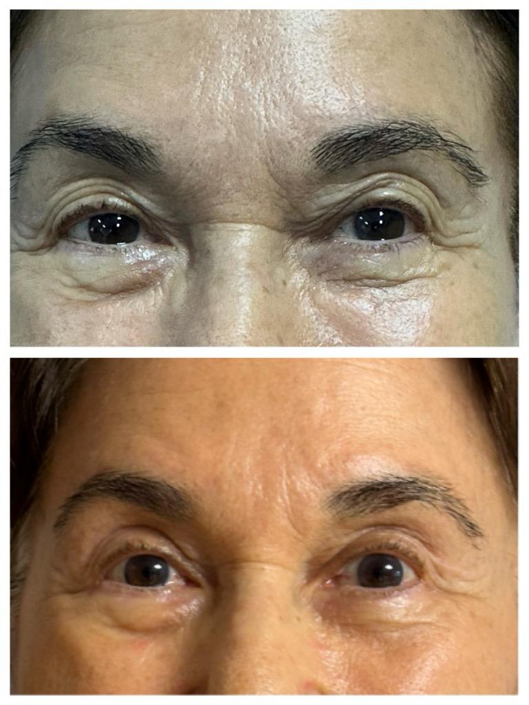 Blefaroplastie - dupa interventie