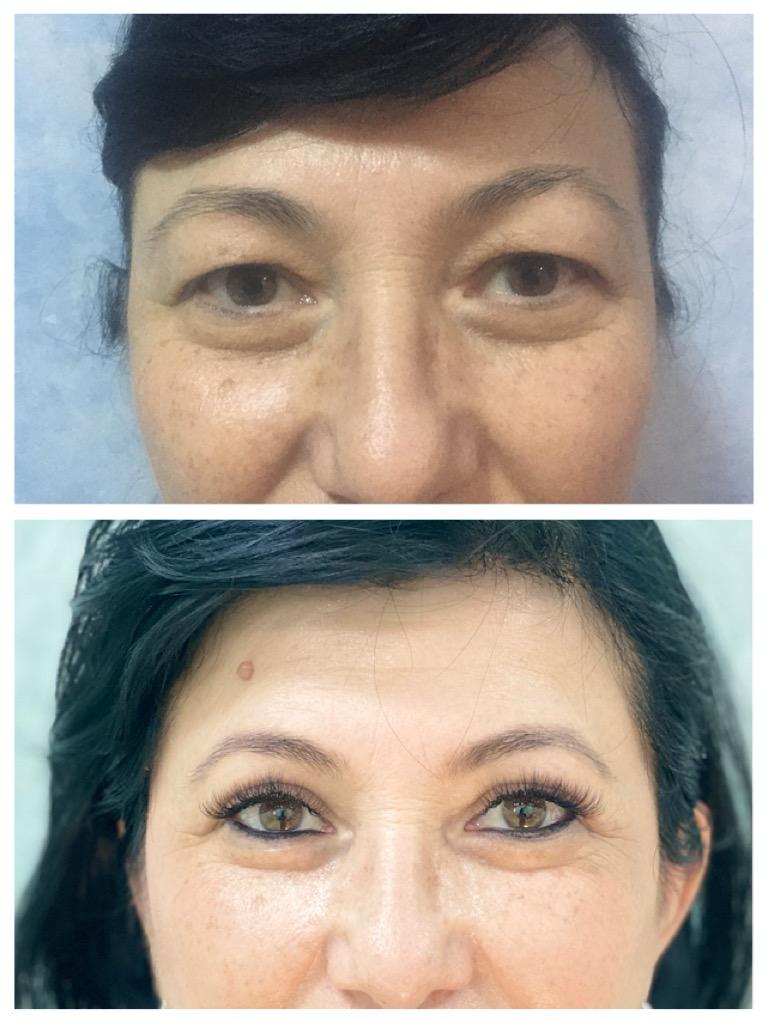 Blefaroplastie - inainte de interventie
