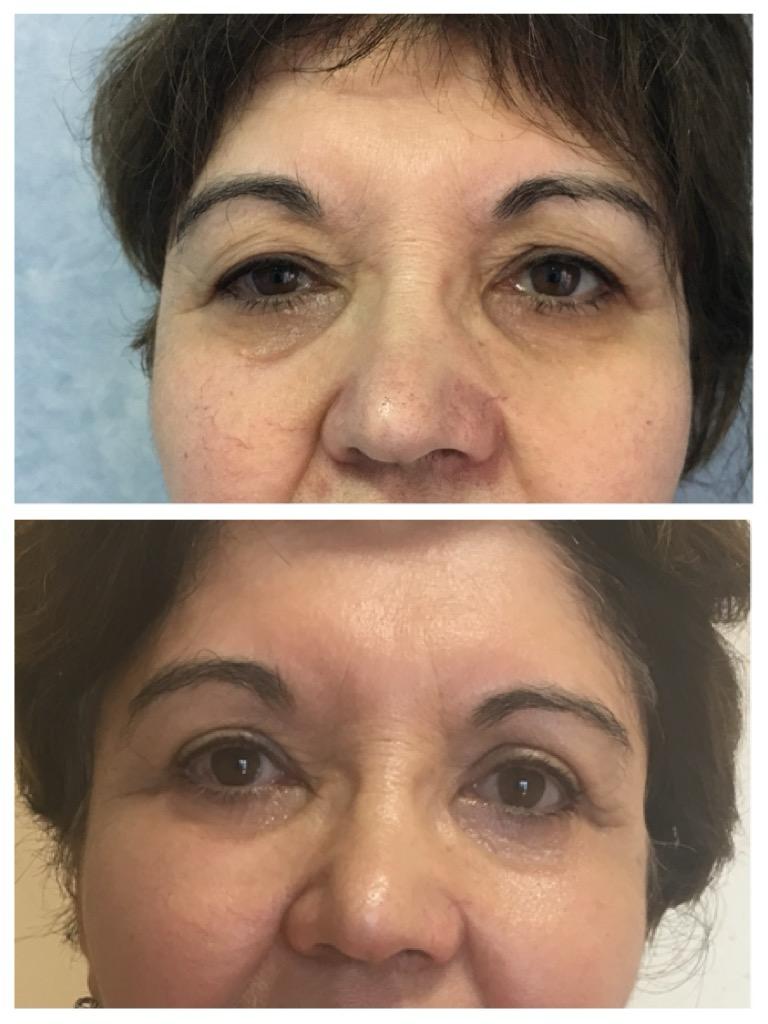 Blefaroplastie - dupa interventie