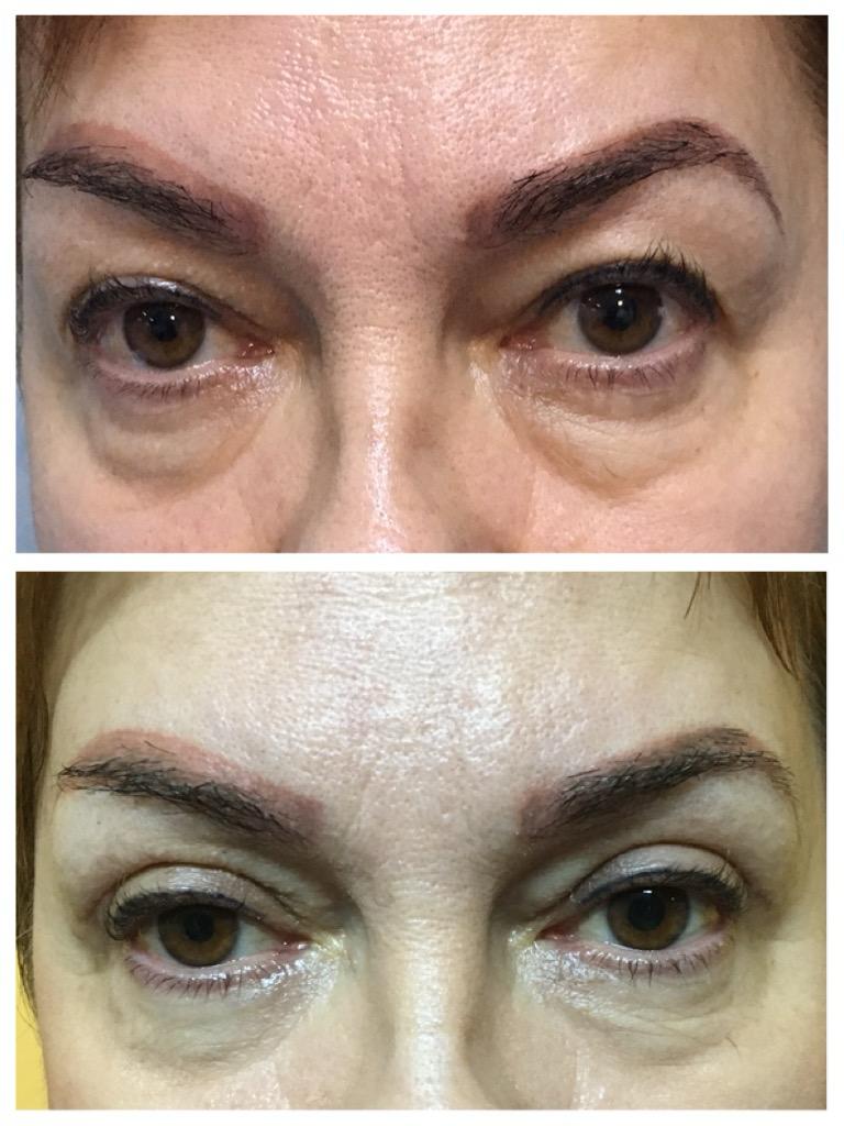 Blefaroplastie - inainte de interventie