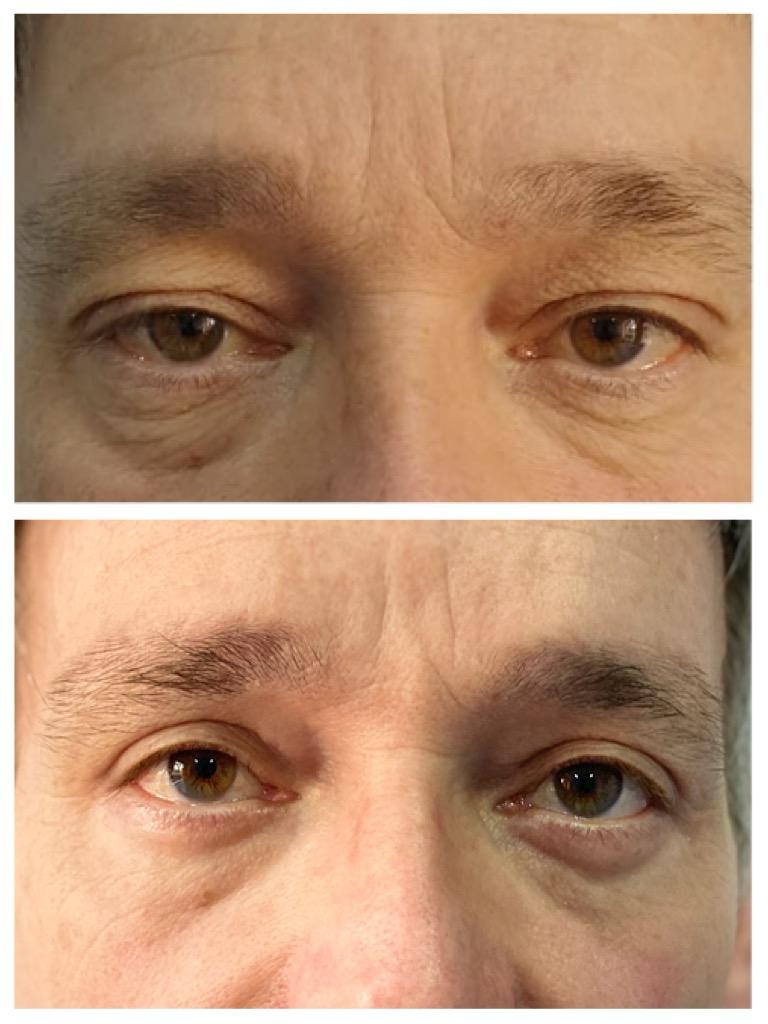 Blefaroplastie - dupa interventie