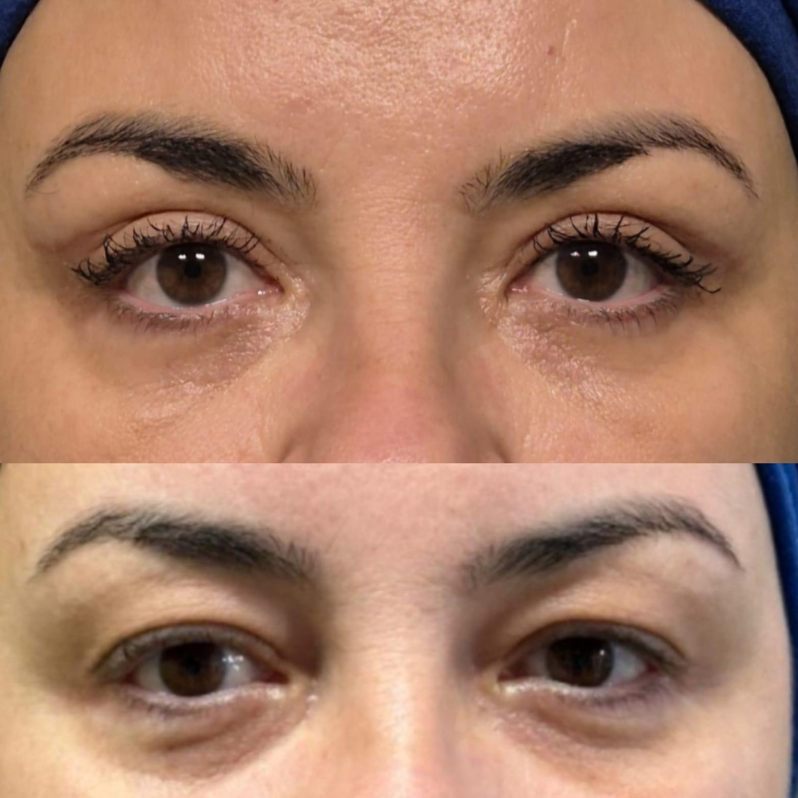 Blefaroplastie - inainte de interventie