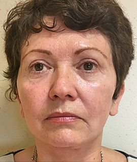 Lifting facial - dupa interventie