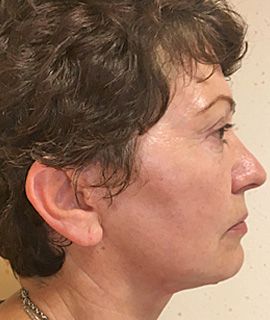 Lifting facial - dupa interventie