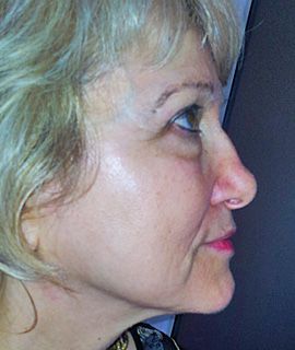 Lifting facial - inainte de 
interventie